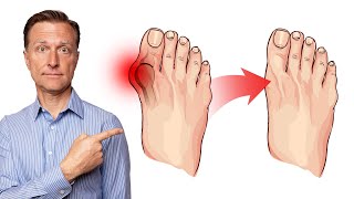 How to Fix Bunions in 3 Steps [upl. by Ailecra270]