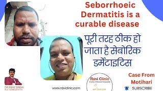 Seborrhoeic Dermatitis Got cured 100  in Online Patient with Homeopathy [upl. by Eiblehs944]