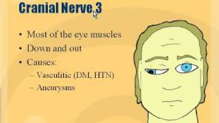 Neuro  Cranial Nerve 3 Palsy [upl. by Sirah241]