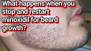 Minoxidil Beard Journey 3 Month Transformation [upl. by Aeikan83]