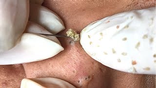 ACNE BLACKHEADS WHITEHEADS REMOVAL on face 38  How to get rid of pimple easy part [upl. by Kissee]