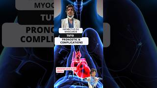 Guide pratique de l’infarctus du myocarde Tutoriel essentiel pour les infirmiers ide tuto tips [upl. by Dirgis]