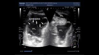 Ultrasound Video showing partial intestinal obstruction with thick free fluid in the pelvis [upl. by Earazed]