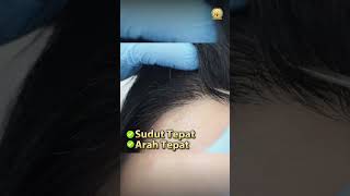 Hairline Transplant 10 Bulan Perjalanan SMART™ FUE  HAIR TRANSPLANT MALAYSIA [upl. by Krenek]