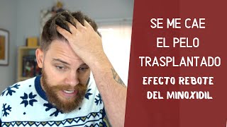 SE ME HA CAÍDO EL PELO TRASPLANTADO SUFRO EL EFECTO REBOTE DEL MINOXIDIL [upl. by Thagard]