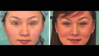 Asian Nose Surgery  January 2013 by Dr Charles S Lee [upl. by Nodmac]