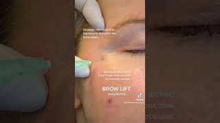 How to Safely amp Effectively Use Botox for Brow Lift [upl. by Annaek]