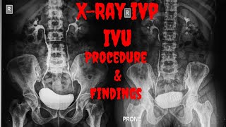 XRAY IVP  XRAY IVU Procedure Indications Findings  Intravenous Urogram  Intravenous Pyelogram [upl. by Westney]