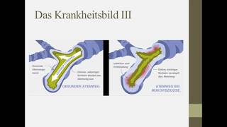 Erklärung des Gendefekts Mukoviszidose [upl. by Base]
