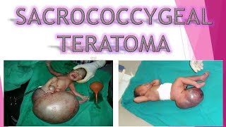 WHAT IS SACROCOCCYGEAL TERATOMA SCT ALL ABOUT ITS CAUSES SYMPTOMS PATHOLOGY DIAGNOSIS TREATMENT [upl. by Vanna]