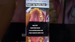 Rapid Palatal Expander How To Use It shortsfeed dentist 3ddentistry RapidPalatalExpander brace [upl. by Kaiulani]