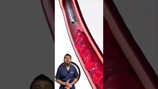 Blood clots ඉවත් කරන thrombectony [upl. by Stedman991]