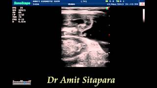 Hydrostatic reduction of Intussusception Sonography guaidedFinal [upl. by Cavan]