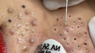 Treatment Of Blackheads And Acne Hidden Under The Chin [upl. by Eseeryt807]