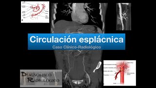 Caso Circulación Colateral Esplácnica [upl. by Hgiel197]