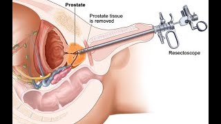 TURP explained and animation [upl. by Ramberg]