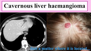 cavernous liver haemangioma [upl. by Kaspar288]