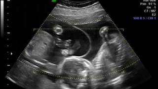 Ramos Twins  21 Weeks Ultrasound [upl. by Anai]