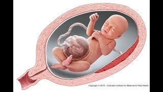 How to Omphalocele  causes symptoms diagnosis treatment pathology [upl. by Doelling]