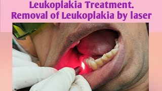 Leukoplakia TreatmentRemoval of Leukoplakia by laser SurgeryHow to remove Leukoplakia by lasersurg [upl. by Nnanaej]