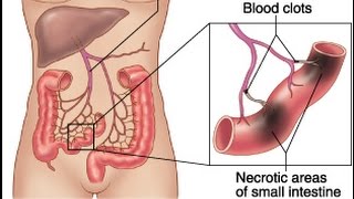 Mesenteric Ischemia [upl. by Leen]