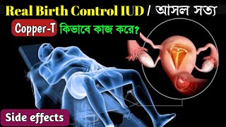 How IUD Works to Prevent Pregnancy Animation। Copper T Insertion and Side Effects । [upl. by Williamson81]