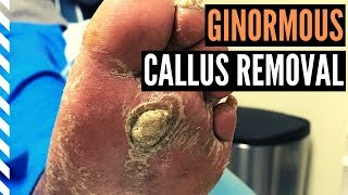 Ginormous Callus Removal [upl. by Riordan]