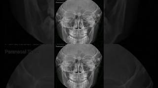 The XRay of the paranasal sinus PNS [upl. by Lladnik]