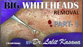 BIG WHITEHEADS REMOVAL PART1 [upl. by Eiramaneet]