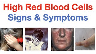 High Red Blood Cells Polycythemia Signs amp Symptoms amp Why They Occur [upl. by Enelram]