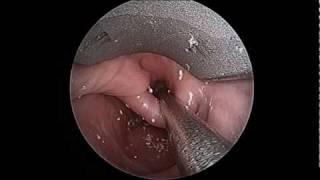 Zenkers Diverticulum Prior to Endoscopic Repair [upl. by Cadel]