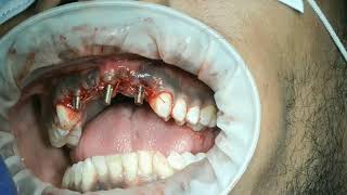 part 1failed apicoectomy upper incisors extraction and 3 single piece implant surgery [upl. by Lhok]