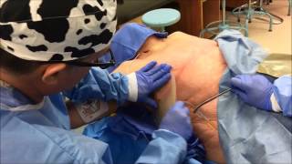 Securing a Chest Tube with a Halo Chest Seal [upl. by Vallonia]