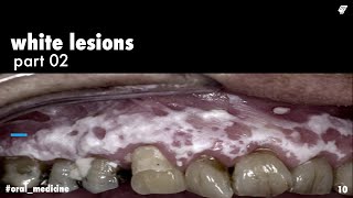 white lesions  leukoplakia 1  oral medicine  عزت شومان [upl. by Petracca733]