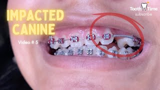 Impacted Canine Braces Treatment  6 Months progress  Video 5  Tooth Time Family Dentistry [upl. by Leah691]