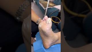 Plantar warts removal That is hard to treat plantar wart So many warts on the foot [upl. by Bonnie]