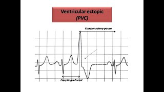 ECG course Ectopics in ECG Dr Sherif Altoukhy [upl. by Llednav]