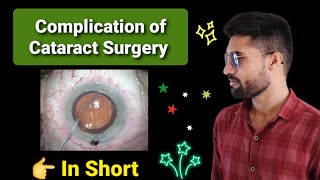 Complication of cataract surgery lecture opthalmology [upl. by Ettenwahs]