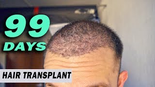 FUE Hair Transplant DAY 99 post op Istanbul Turkey GORWTH STAGE [upl. by Mast]