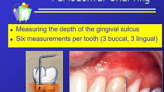 Charting Sequence and Periodontal Charting [upl. by Audrey375]