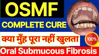 OSMF Treatment in Hindi  Oral Submucosis Fibrosis  Oral Submucous Fibrosis in Hindi  Homeopathy [upl. by Coleman]