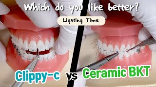 Self ligating bracesclippyc vs normal braces Ligation Time korea dentalGangnam [upl. by Duile]