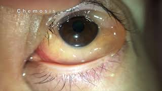 Chemosis of Conjunctiva [upl. by Callery]