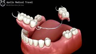 Animated Removable Partial Dentures  Apollo Medical Travel [upl. by Adnama]