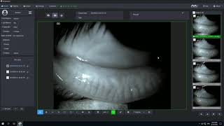 Meibomian Gland Analysis in Mediview [upl. by Yggam]