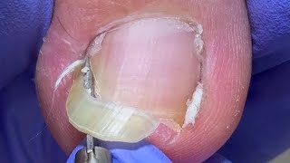 Pedicure Tutorial The Complete Trim Process for a Huge Ingrown Toenail [upl. by Amii259]