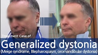 Generalized dystonia  Meige syndrome  Blepharospasm oromandibular dystonia  전신사경증 치료사례 [upl. by Jegger210]