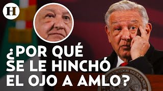 ¡AMLO tiene el ojo derecho hinchado por un “tutupiche” Qué es síntomas causas y tratamiento [upl. by Young]