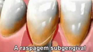 Periodontia Doença Periodontal Gengiva Retração Gengival Espaço Perio Odontologia [upl. by Aleacim299]