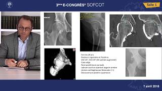 DYSPLASIE DE HANCHE  BUTEE  SOO  Dr GEDOUIN [upl. by Siuqaj]